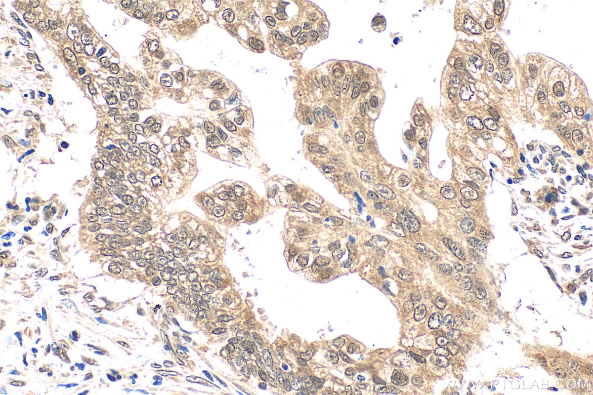 IHC staining of human pancreas cancer using 55326-1-AP (same clone as 55326-1-PBS) Immunohistochemistry (IHC) staining of human pancreas cancer tissue using QSER1 Polyclonal antibody (55326-1-AP)