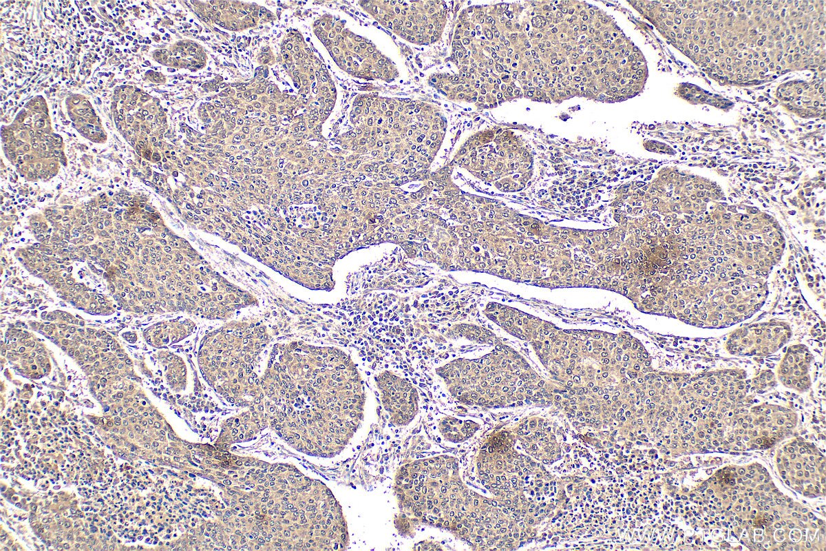 IHC staining of human lung cancer using 55326-1-AP Immunohistochemistry (IHC) staining of human lung cancer tissue using QSER1 Polyclonal antibody (55326-1-AP)