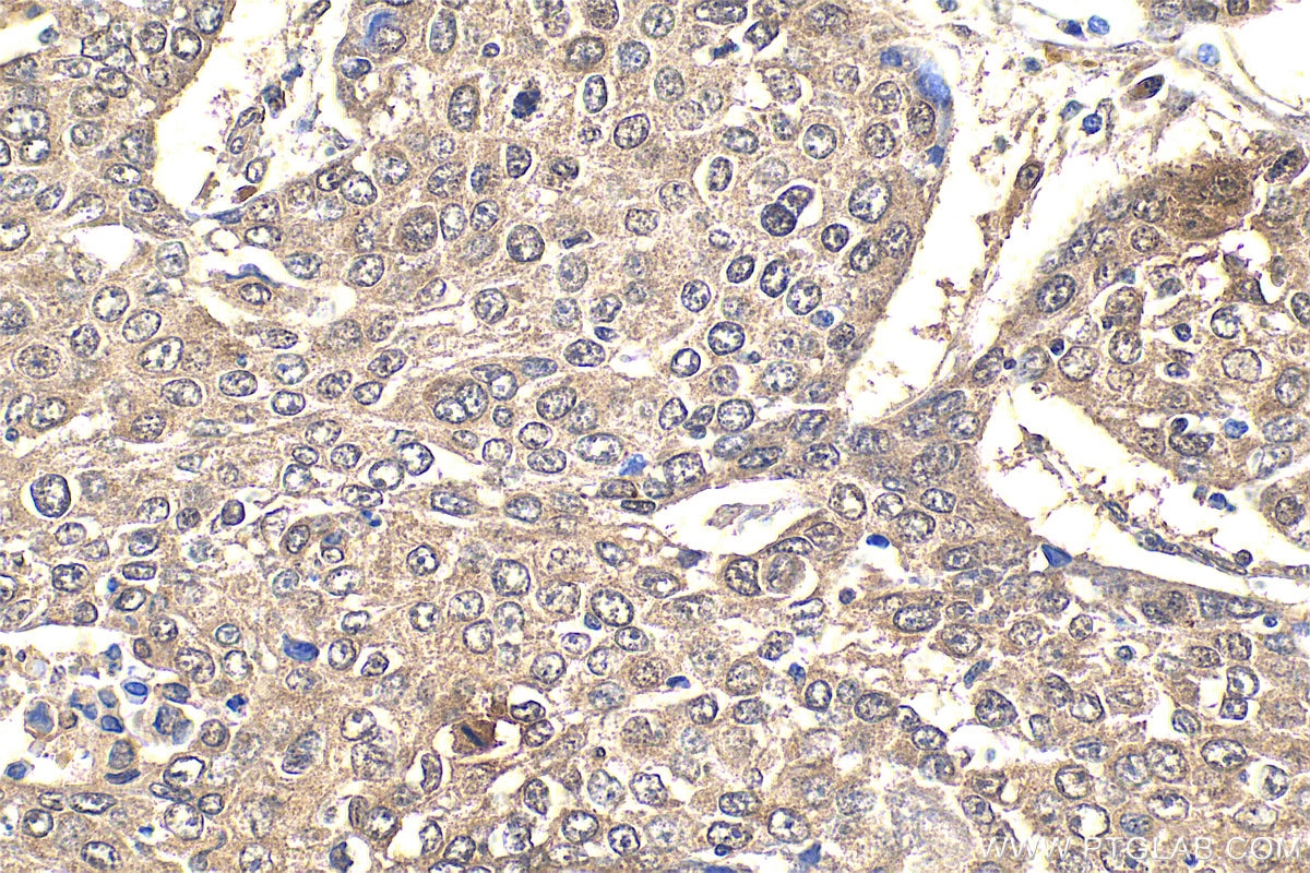 IHC staining of human lung cancer using 55326-1-AP Immunohistochemistry (IHC) staining of human lung cancer tissue using QSER1 Polyclonal antibody (55326-1-AP)