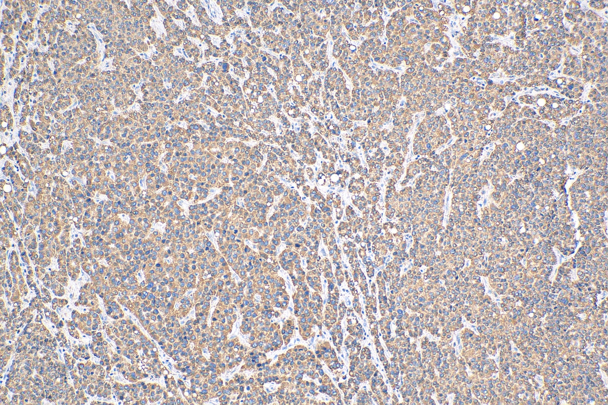 Immunohistochemistry (IHC) staining of human liver cancer tissue using QSOX1 Polyclonal antibody (12713-1-AP)