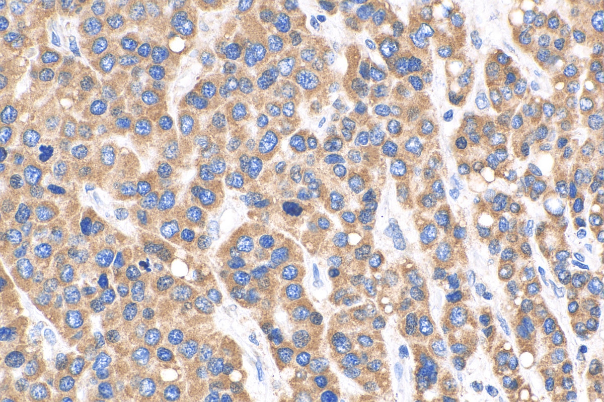 Immunohistochemistry (IHC) staining of human liver cancer tissue using QSOX1 Polyclonal antibody (12713-1-AP)