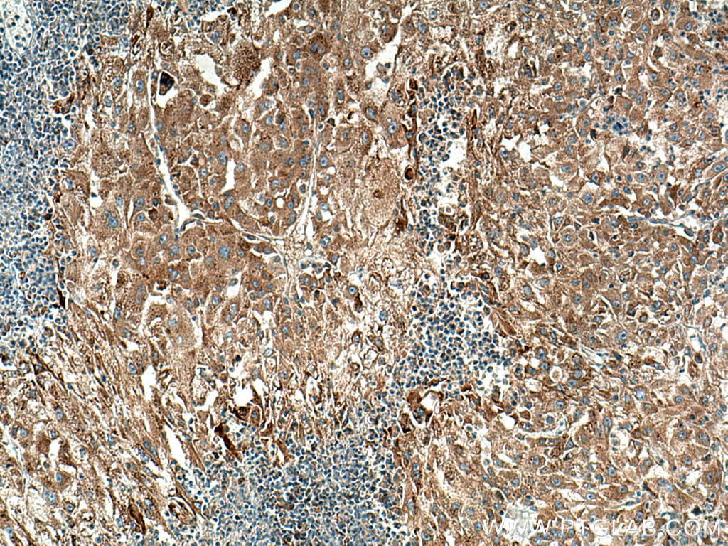 Immunohistochemistry (IHC) staining of human liver cancer tissue using RAB10 Polyclonal antibody (11808-1-AP)