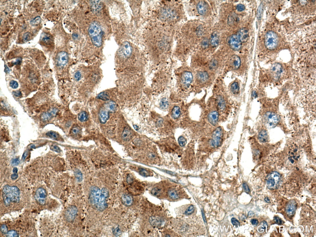 Immunohistochemistry (IHC) staining of human liver cancer tissue using RAB10 Polyclonal antibody (11808-1-AP)