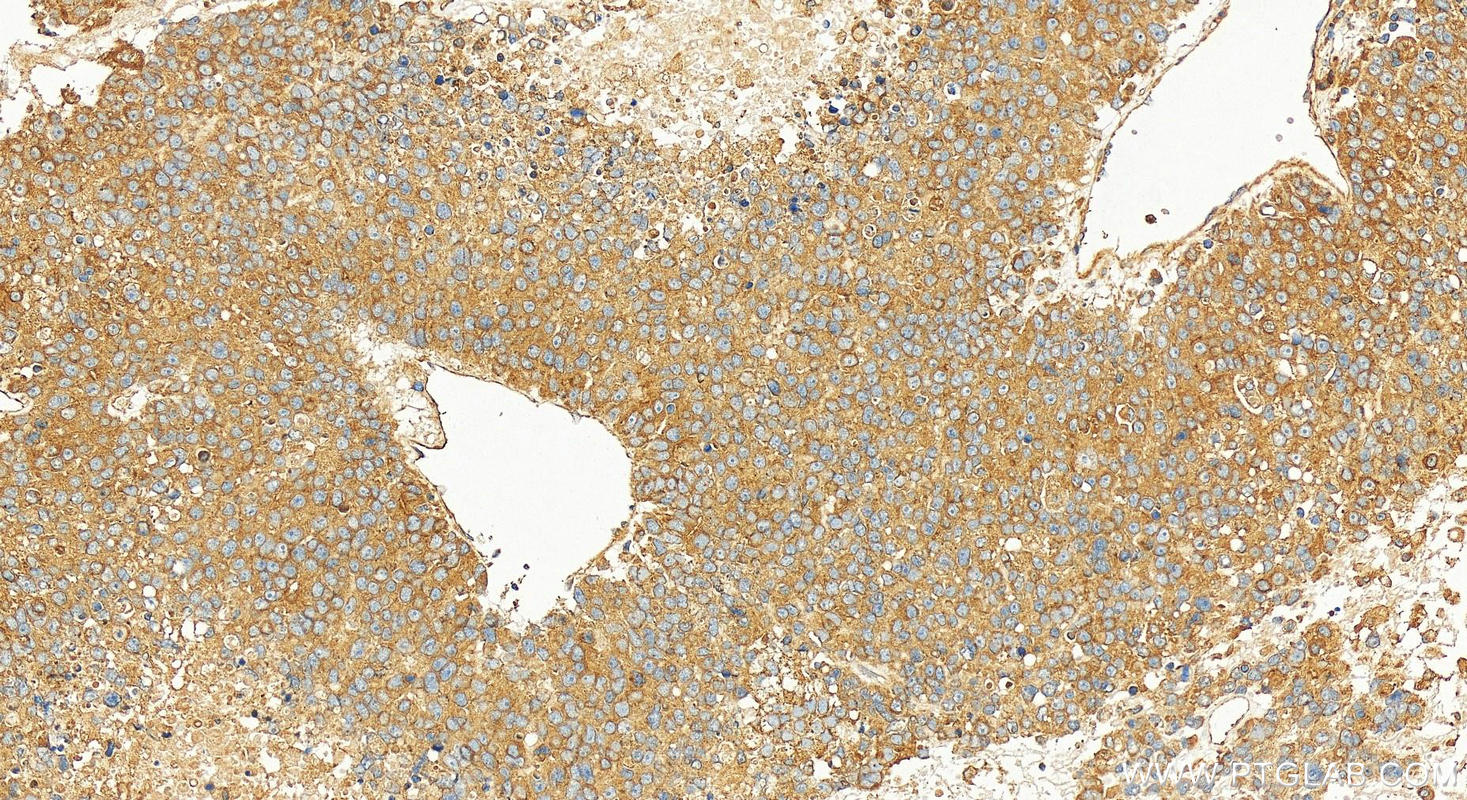 Immunohistochemistry (IHC) staining of human hepatocellular carcinoma using RAB10 Polyclonal antibody (27094-1-AP)