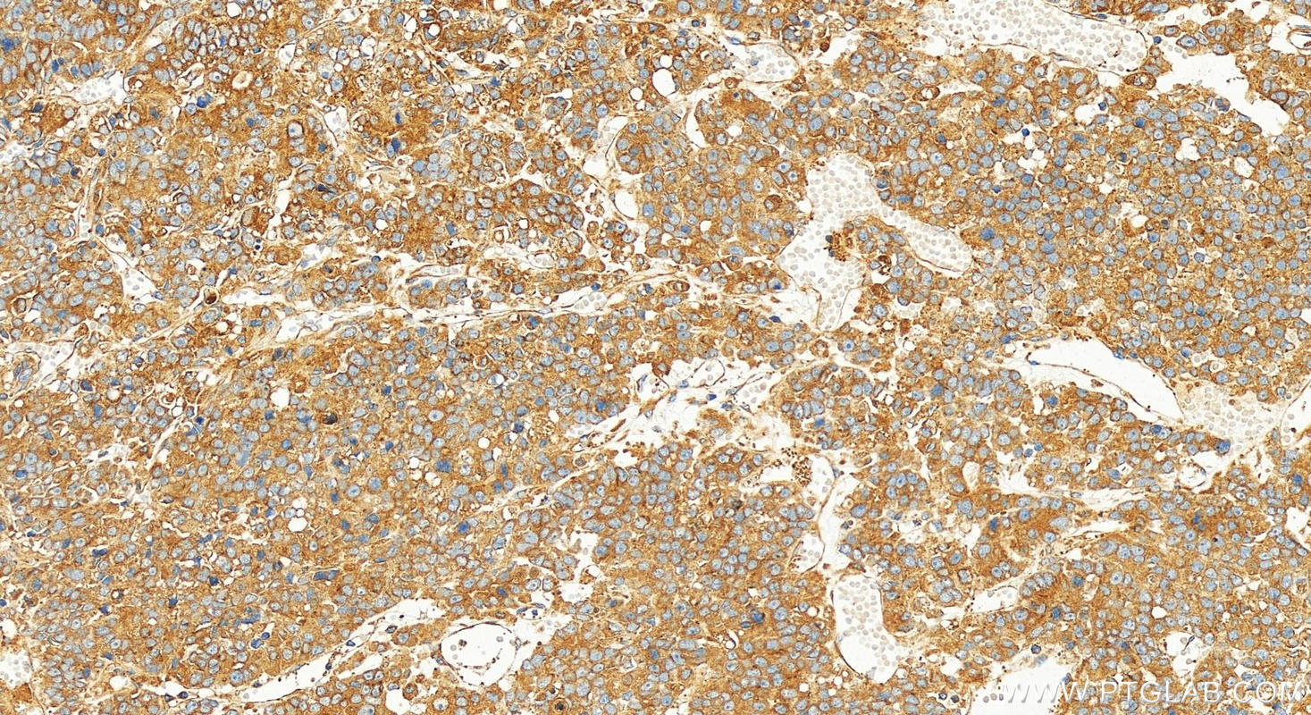 Immunohistochemistry (IHC) staining of human hepatocellular carcinoma using RAB10 Polyclonal antibody (27094-1-AP)