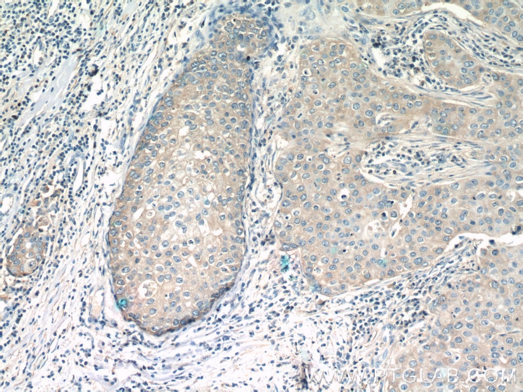 Immunohistochemistry (IHC) staining of human breast cancer tissue using RAB11FIP1 Polyclonal antibody (16778-1-AP)