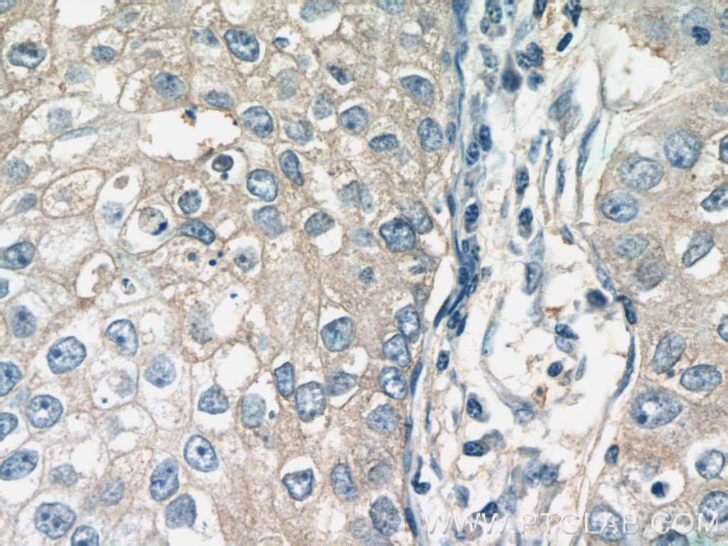 Immunohistochemistry (IHC) staining of human breast cancer tissue using RAB11FIP1 Polyclonal antibody (16778-1-AP)