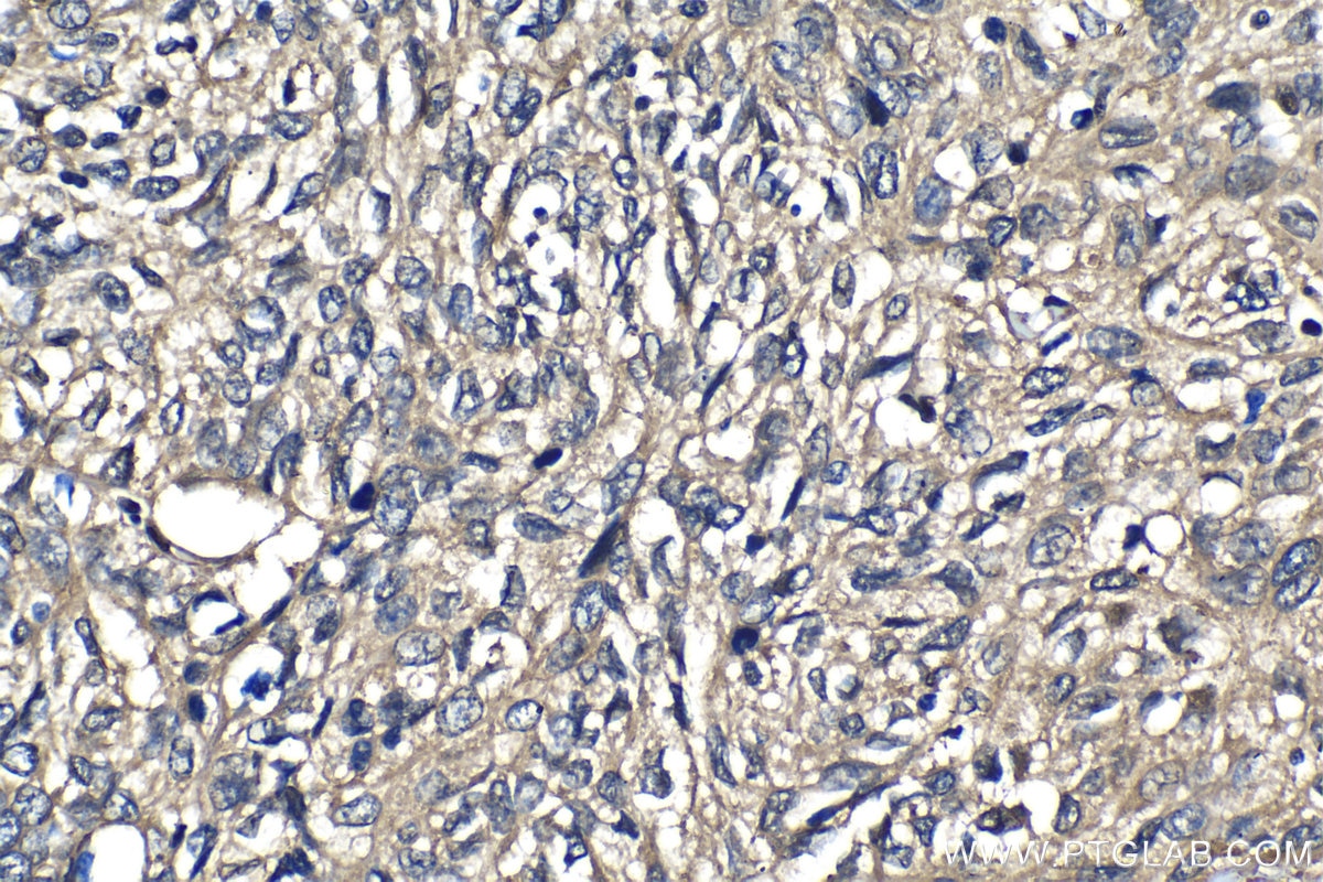 Immunohistochemistry (IHC) staining of human cervical cancer tissue using RAB11FIP5 Polyclonal antibody (14594-1-AP)