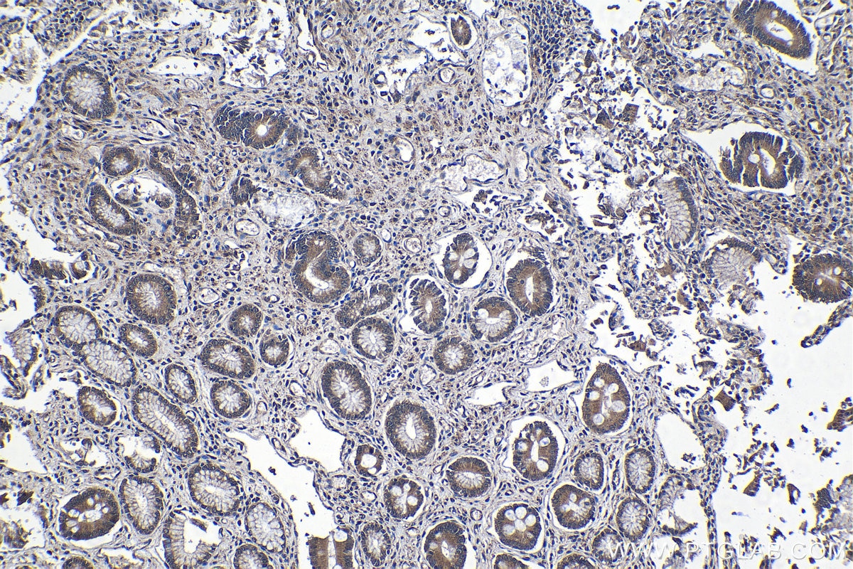 Immunohistochemistry (IHC) staining of human stomach cancer tissue using RAB11FIP5 Polyclonal antibody (14594-1-AP)