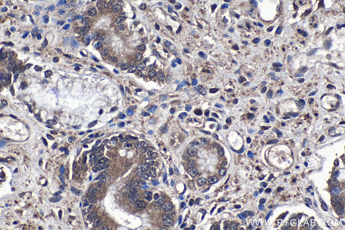 Immunohistochemistry (IHC) staining of human stomach cancer tissue using RAB11FIP5 Polyclonal antibody (14594-1-AP)