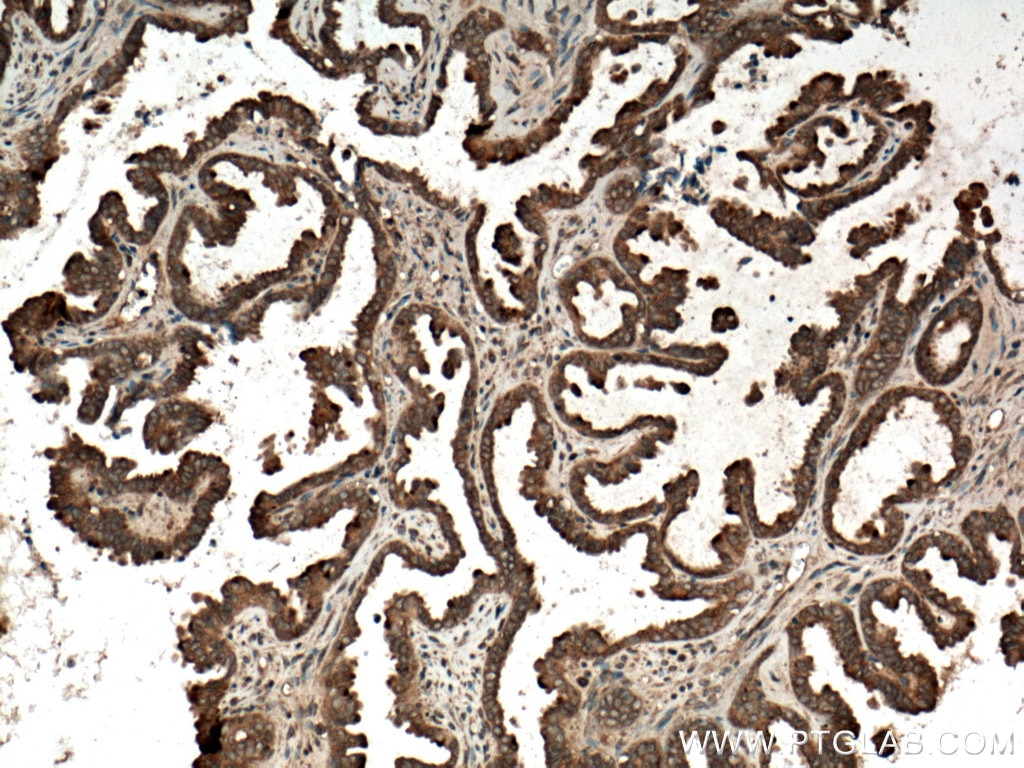 Immunohistochemistry (IHC) staining of human ovary tumor tissue using RAB14 Polyclonal antibody (15662-1-AP)