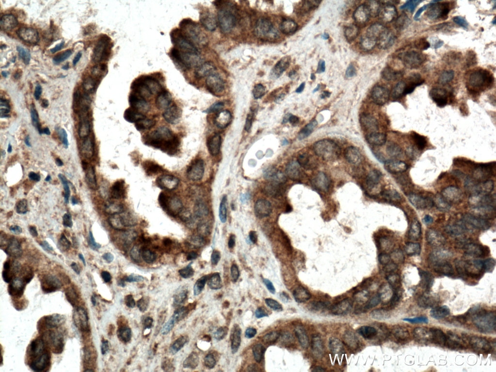 Immunohistochemistry (IHC) staining of human ovary tumor tissue using RAB14 Polyclonal antibody (15662-1-AP)