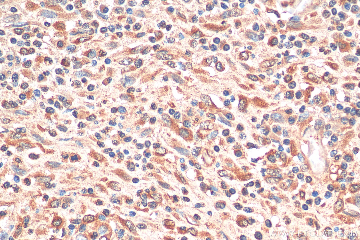 Immunohistochemistry (IHC) staining of human colon cancer tissue using RAB14 Monoclonal antibody (67953-1-Ig)