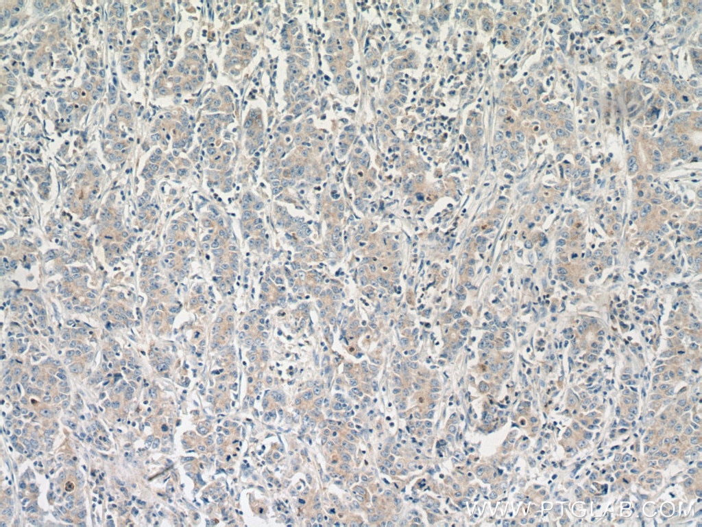 Immunohistochemistry (IHC) staining of human stomach cancer tissue using Rab18 Polyclonal antibody (11304-1-AP)