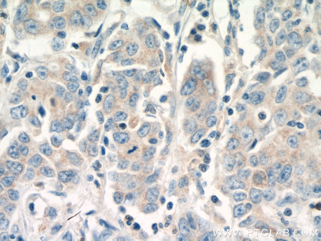 Immunohistochemistry (IHC) staining of human stomach cancer tissue using Rab18 Polyclonal antibody (11304-1-AP)