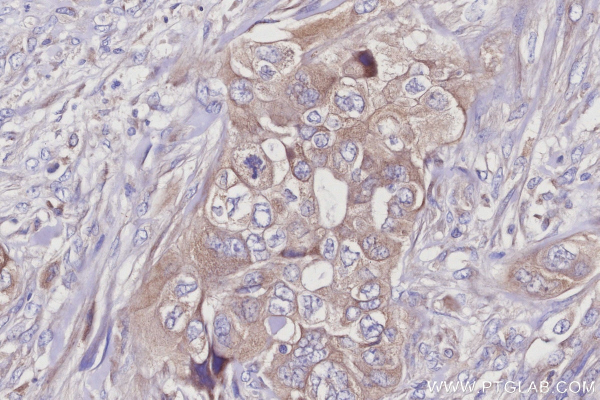Immunohistochemistry (IHC) staining of human pancreas cancer tissue using RAB18 Monoclonal antibody (67659-1-Ig)