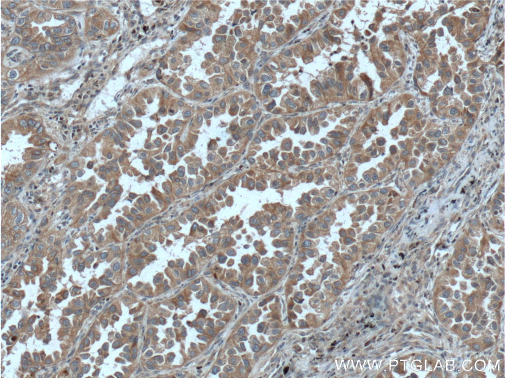 Immunohistochemistry (IHC) staining of human lung cancer tissue using RAB1A Polyclonal antibody (11671-1-AP)