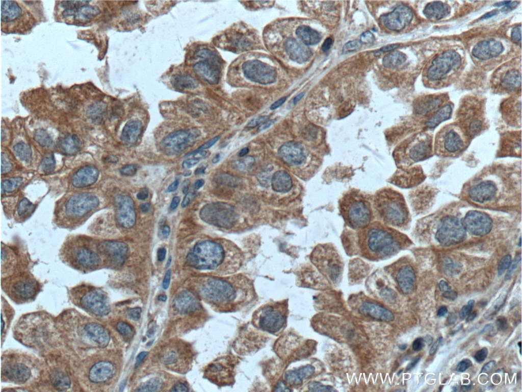 Immunohistochemistry (IHC) staining of human lung cancer tissue using RAB1A Polyclonal antibody (11671-1-AP)