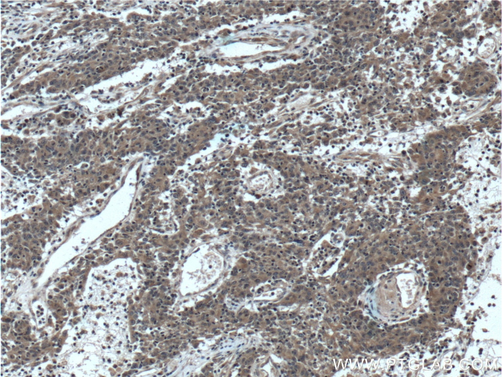 Immunohistochemistry (IHC) staining of human colon cancer tissue using RAB1A Polyclonal antibody (11671-1-AP)