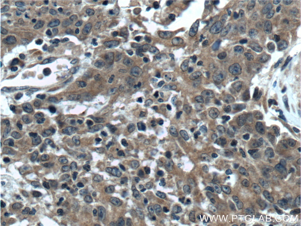 Immunohistochemistry (IHC) staining of human colon cancer tissue using RAB1A Polyclonal antibody (11671-1-AP)