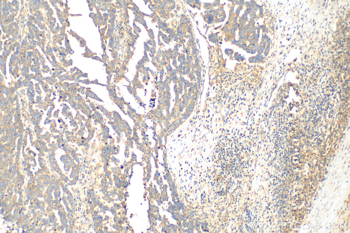 Immunohistochemistry (IHC) staining of human ovary tumor tissue using RAB1B Polyclonal antibody (17824-1-AP)