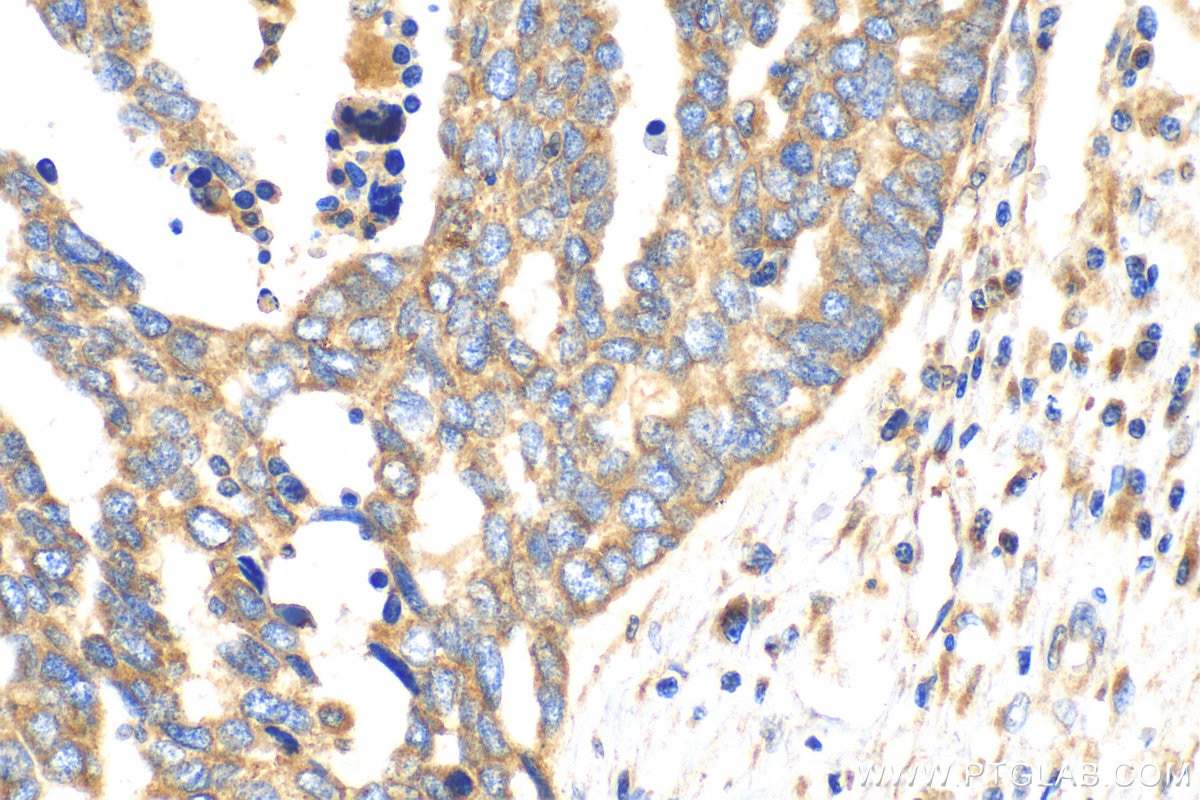 Immunohistochemistry (IHC) staining of human ovary tumor tissue using RAB1B Polyclonal antibody (17824-1-AP)