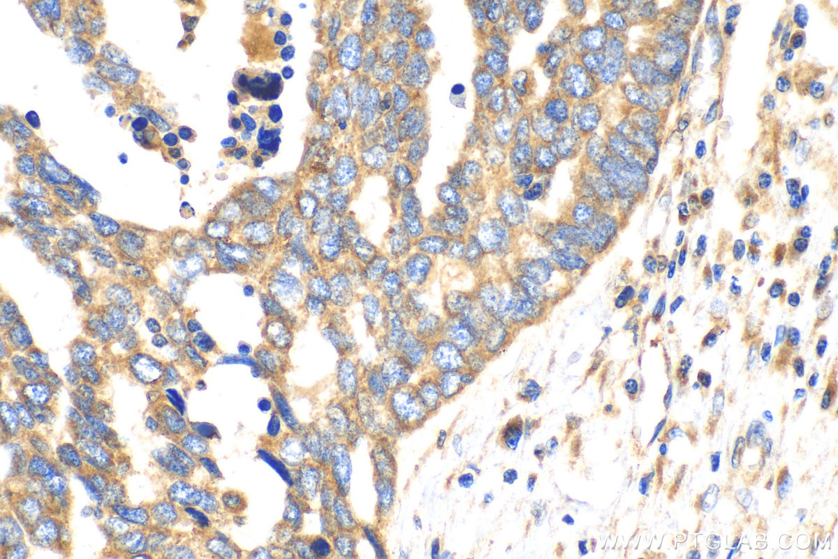 IHC staining of human ovary tumor using 17824-1-AP