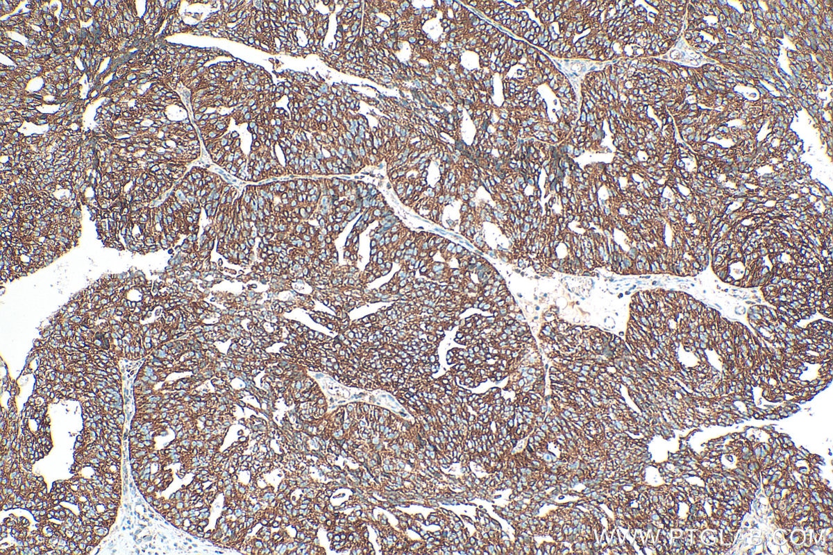 Immunohistochemistry (IHC) staining of human ovary cancer tissue using RAB1B Polyclonal antibody (17824-1-AP)