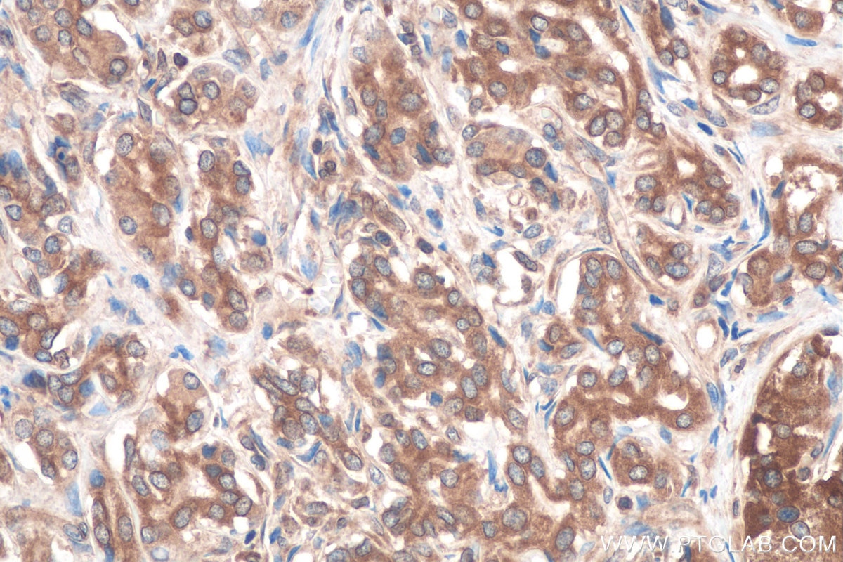 Immunohistochemistry (IHC) staining of human pancreas cancer tissue using RAB1B Monoclonal antibody (67837-1-Ig)