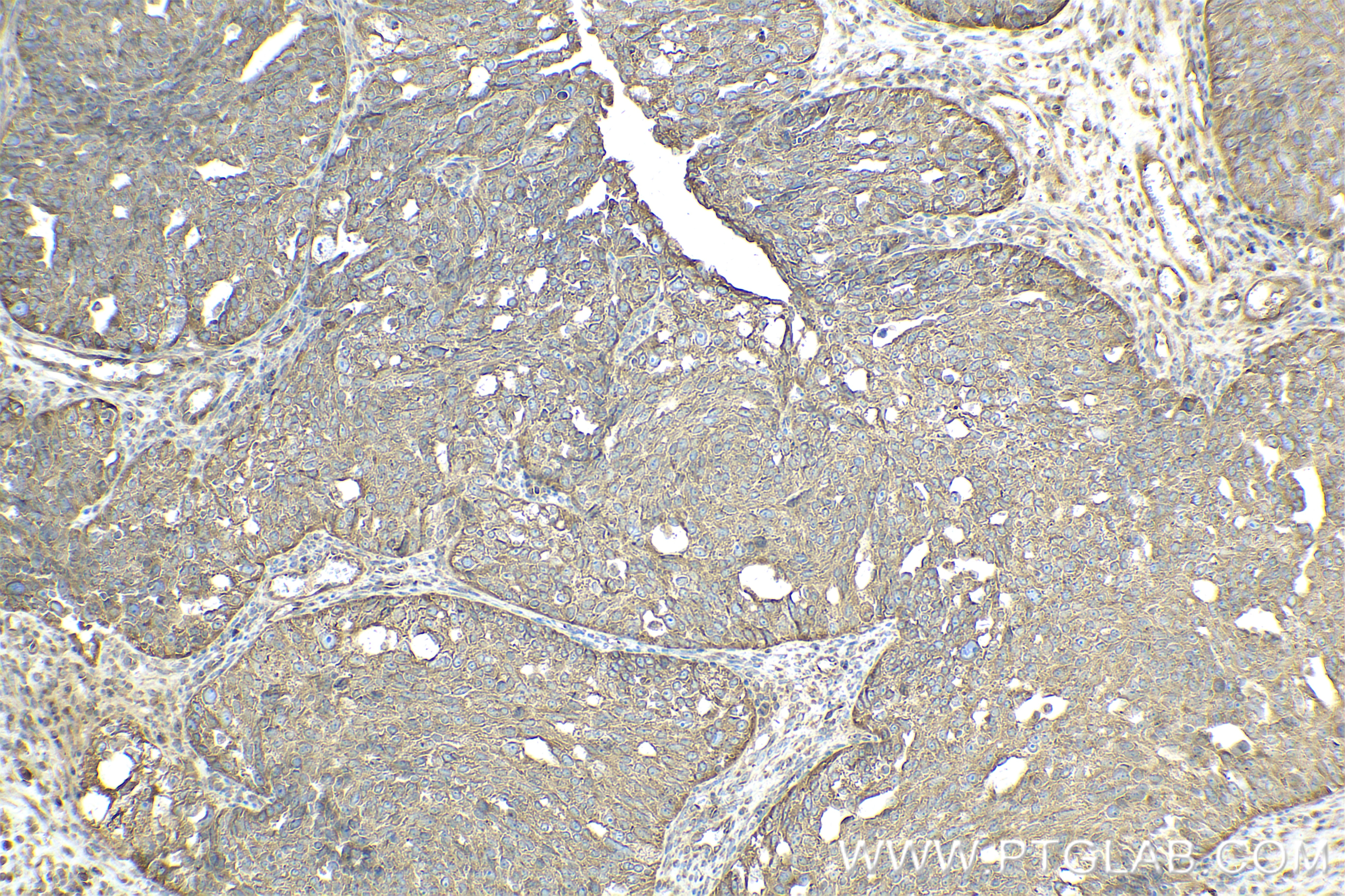 Immunohistochemistry (IHC) staining of human ovary cancer tissue using RAB1B Recombinant antibody (83687-4-RR)