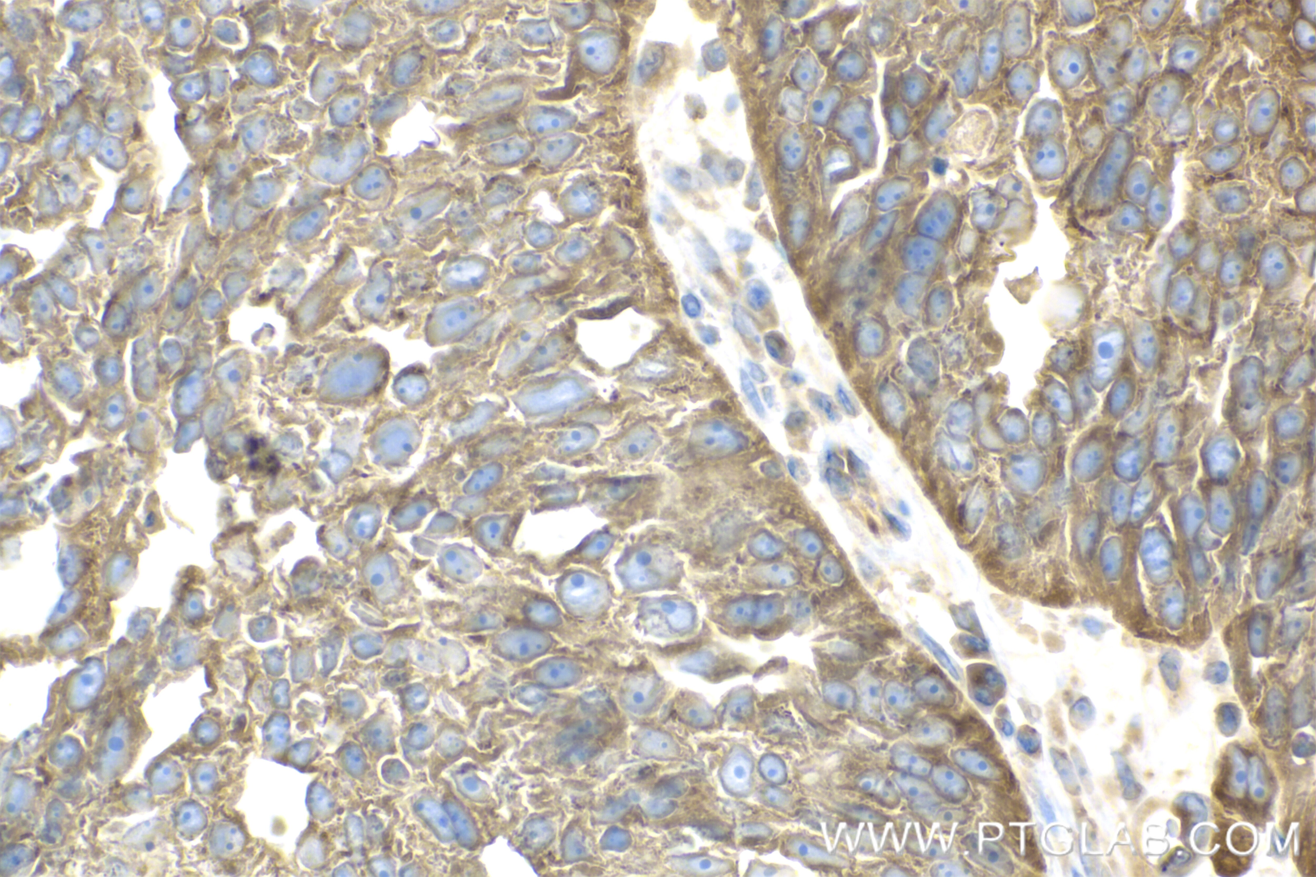 Immunohistochemistry (IHC) staining of human ovary cancer tissue using RAB1B Recombinant antibody (83687-4-RR)