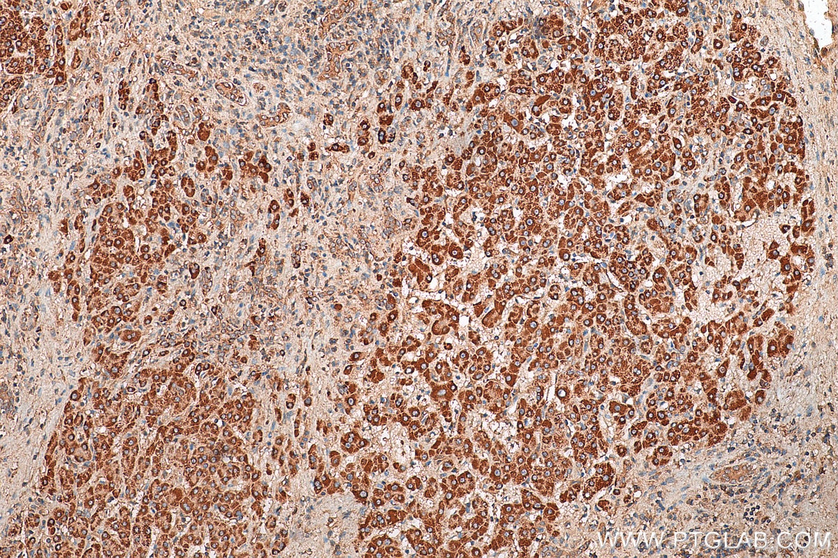 Immunohistochemistry (IHC) staining of human liver cancer tissue using RAB20 Polyclonal antibody (29110-1-AP)