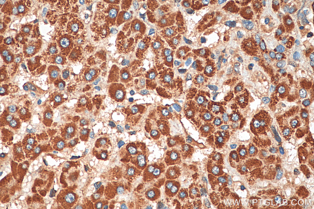 Immunohistochemistry (IHC) staining of human liver cancer tissue using RAB20 Polyclonal antibody (29110-1-AP)