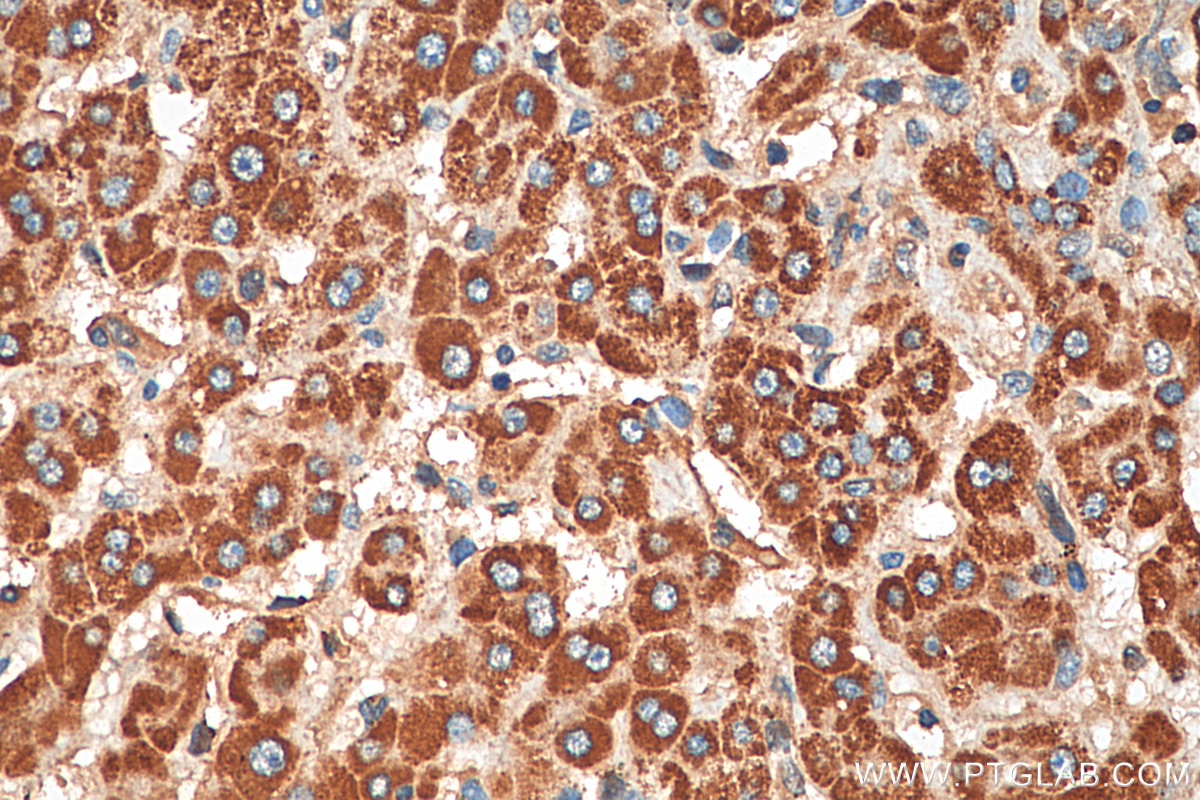 Immunohistochemistry (IHC) staining of human liver cancer tissue using RAB20 Polyclonal antibody (29110-1-AP)