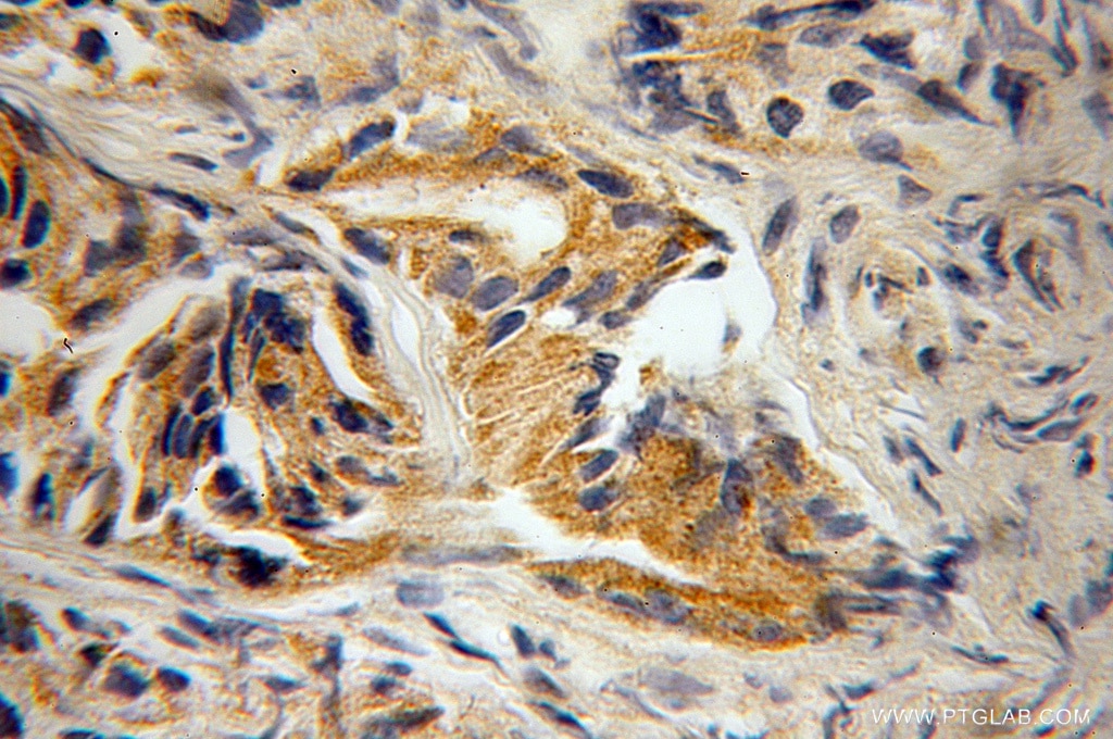 IHC staining of human gliomas using 12125-1-AP