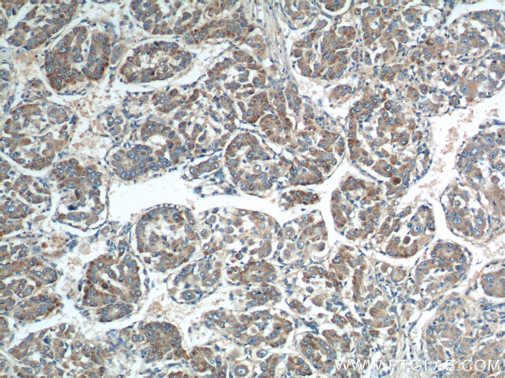 Immunohistochemistry (IHC) staining of human liver cancer tissue using Rab23 Polyclonal antibody (11101-1-AP)