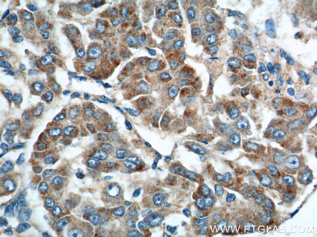 Immunohistochemistry (IHC) staining of human liver cancer tissue using Rab23 Polyclonal antibody (11101-1-AP)