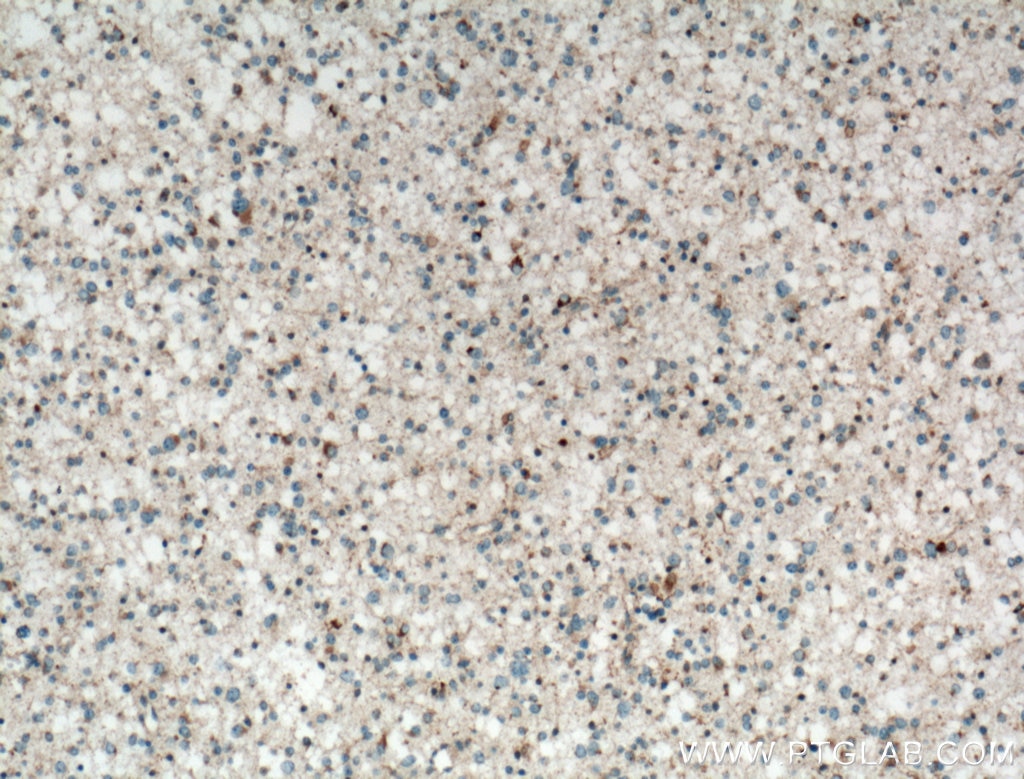 Immunohistochemistry (IHC) staining of human gliomas tissue using RAB24 Polyclonal antibody (11445-1-AP)