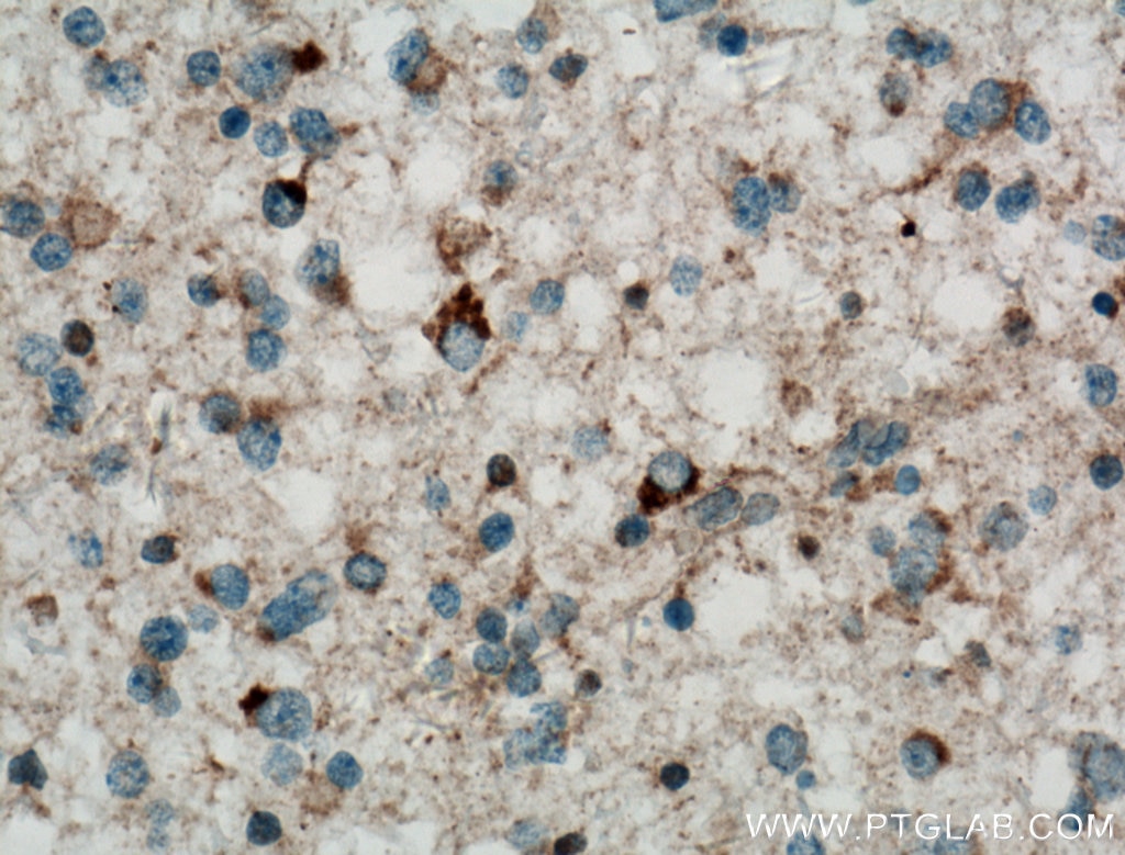 Immunohistochemistry (IHC) staining of human gliomas tissue using RAB24 Polyclonal antibody (11445-1-AP)