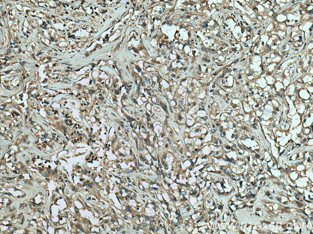 Immunohistochemistry (IHC) staining of human renal cell carcinoma tissue using RAB25 Polyclonal antibody (13189-1-AP)
