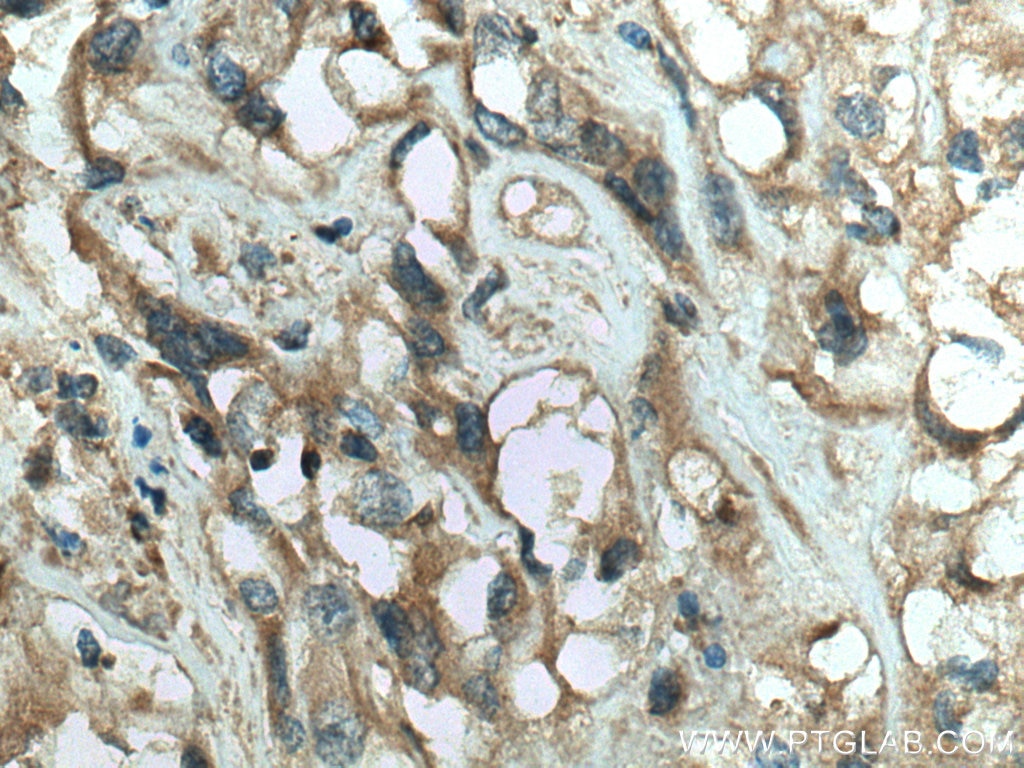 IHC staining of human renal cell carcinoma using 13189-1-AP
