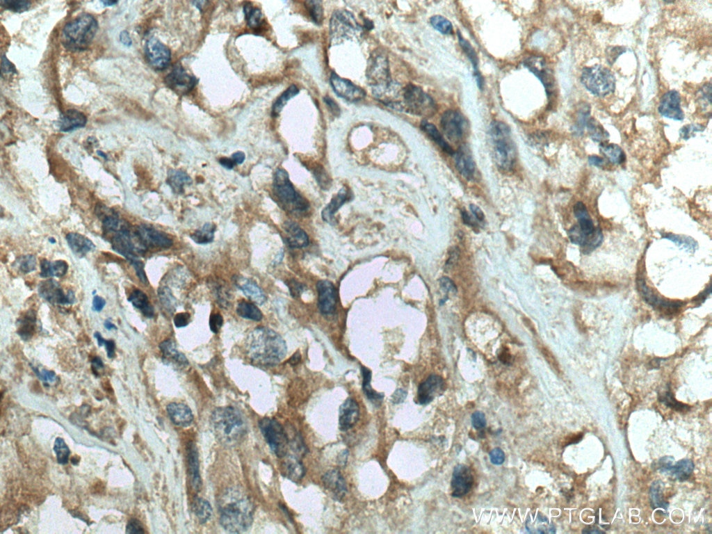 Immunohistochemistry (IHC) staining of human renal cell carcinoma tissue using RAB25 Polyclonal antibody (13189-1-AP)