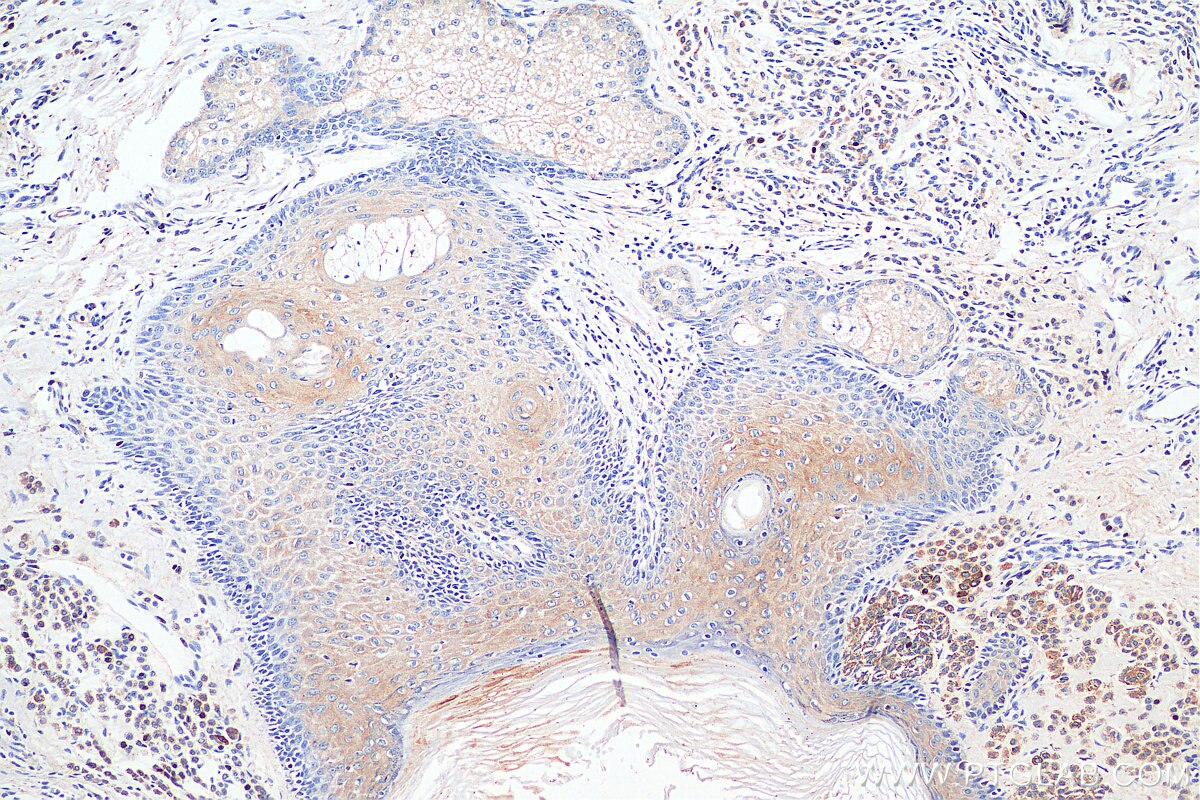 IHC staining of human malignant melanoma using 17817-1-AP