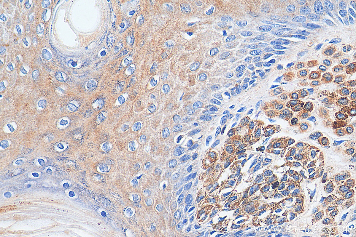 Immunohistochemistry (IHC) staining of human malignant melanoma tissue using RAB27A Polyclonal antibody (17817-1-AP)
