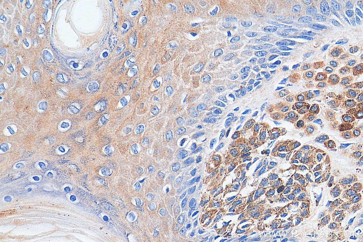 IHC staining of human malignant melanoma using 17817-1-AP