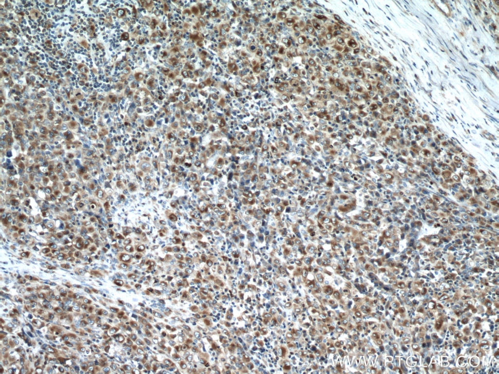 Immunohistochemistry (IHC) staining of human lymphoma tissue using RAB27A Monoclonal antibody (66058-1-Ig)