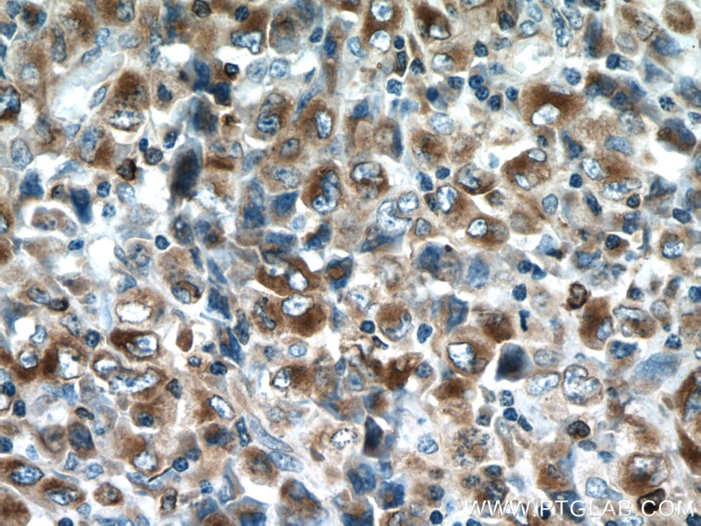 Immunohistochemistry (IHC) staining of human lymphoma tissue using RAB27A Monoclonal antibody (66058-1-Ig)