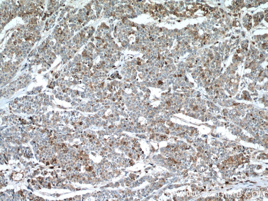 Immunohistochemistry (IHC) staining of human colon cancer tissue using RAB27A Monoclonal antibody (66058-1-Ig)