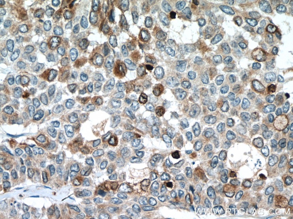 Immunohistochemistry (IHC) staining of human colon cancer tissue using RAB27A Monoclonal antibody (66058-1-Ig)