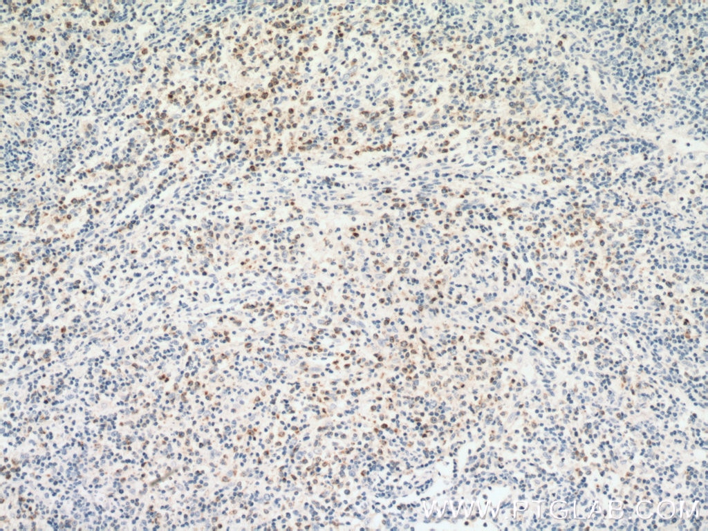 Immunohistochemistry (IHC) staining of human lymphoma tissue using RAB27A-specific Polyclonal antibody (16868-1-AP)